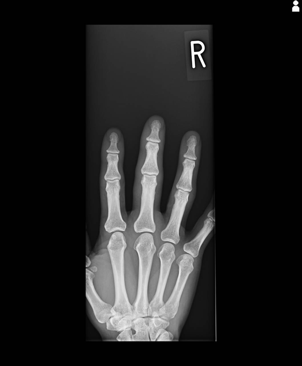 大鳥居にある整骨院　ソフトボールで指を骨折された方の施術