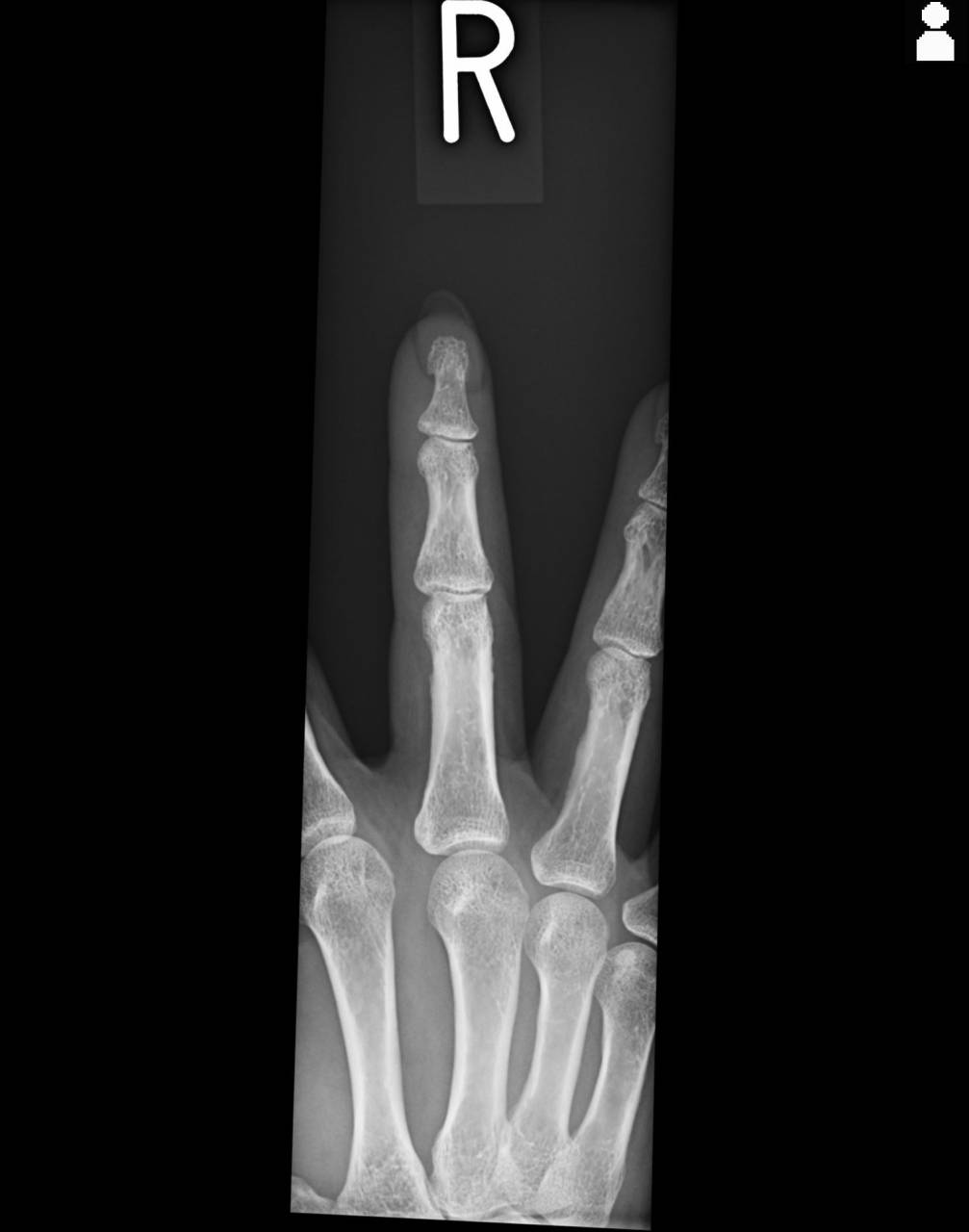 指の骨折のある方の検査・施術について　大鳥居にある整骨院