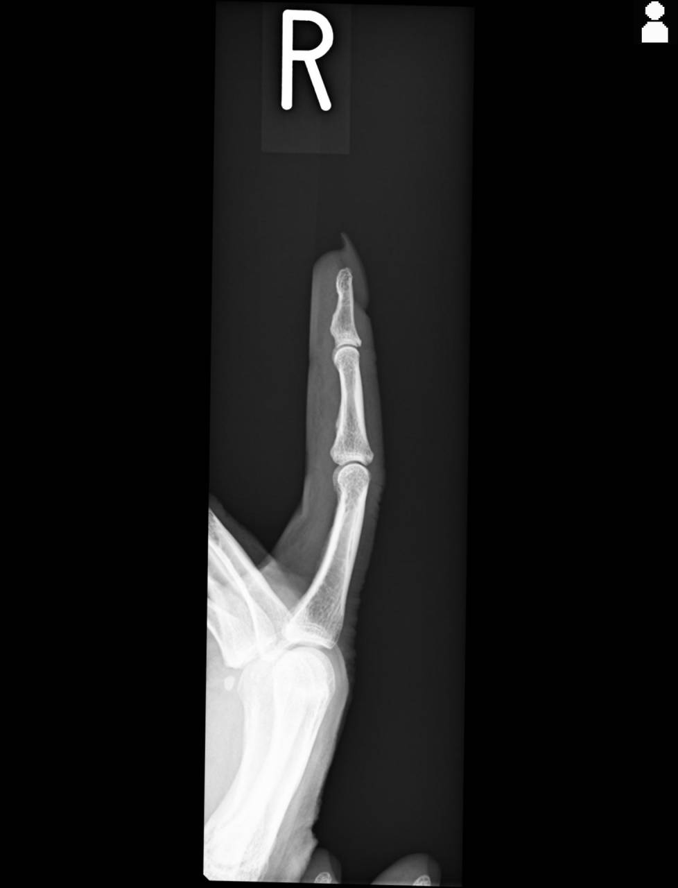 指の骨折のある方の検査・施術について　大鳥居にある整骨院