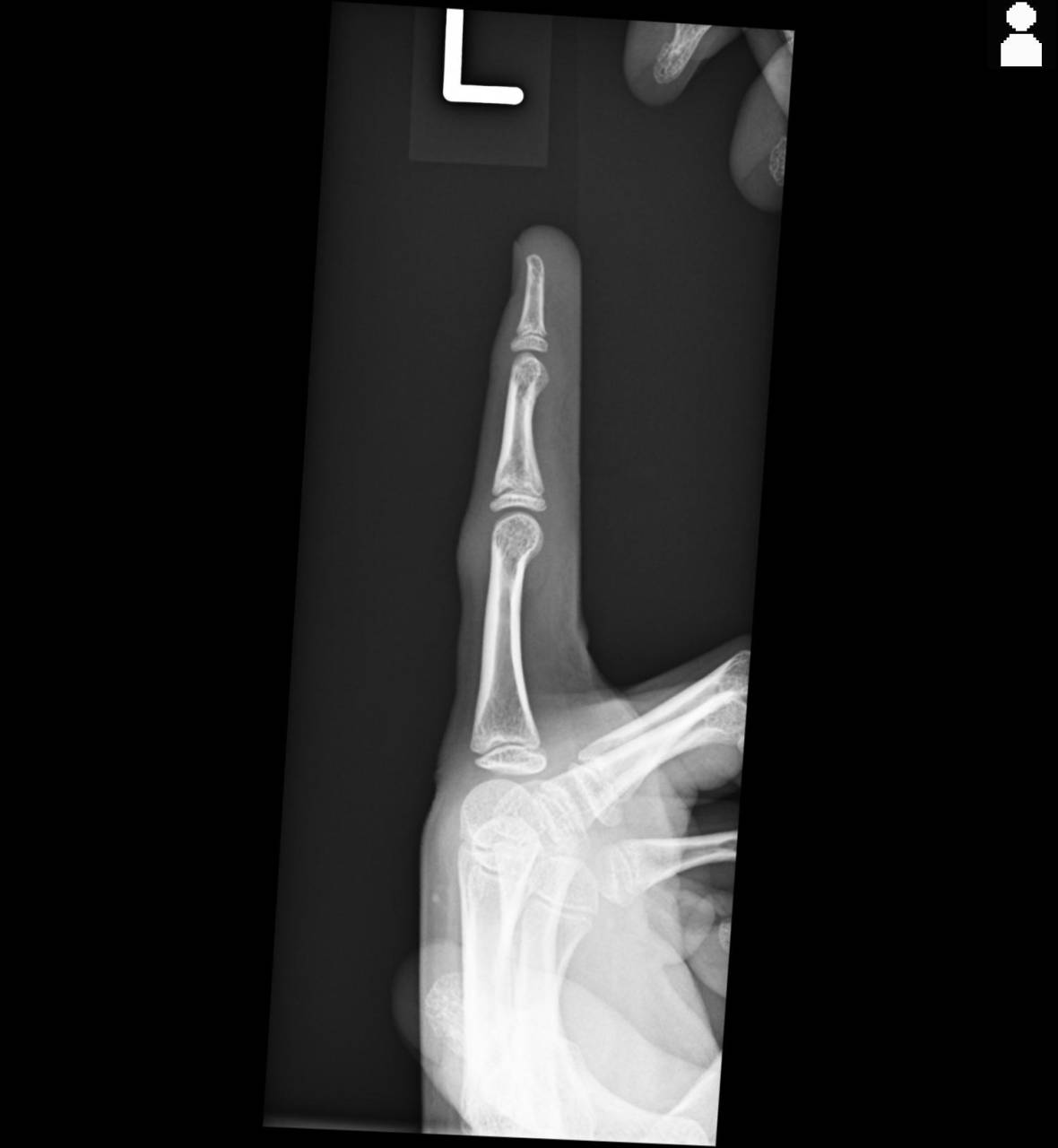 体育のバスケで指を骨折した学生の施術　大鳥居にある整骨院