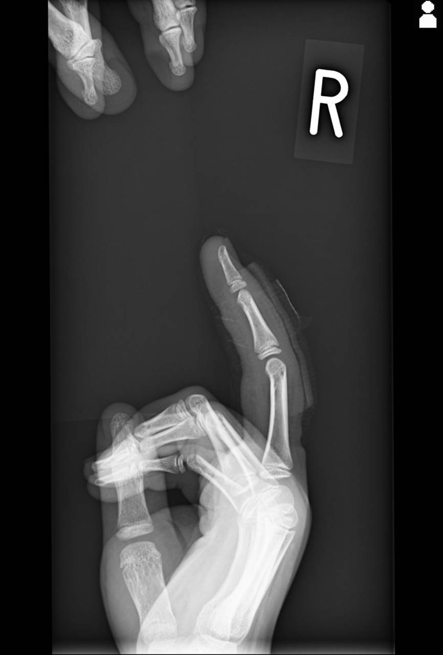 サッカーの試合で指を怪我した学生の初回対応と施術　大鳥居にある整骨院