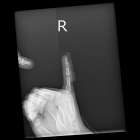 スポーツで指の怪我した学生の初回対応と施術　大鳥居にある整骨院