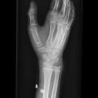 バスケットボールのプレー中に手を衝いて怪我した学生の初回対応と施術　大鳥居にある整骨院